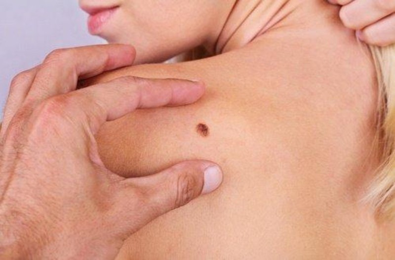Δωρεάν εξετάσεις για την πρόληψη του καρκίνου του δέρματος